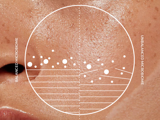 Close-up of a person's skin with a circular diagram overlay. The left side represents a "Balanced Microbiome" and the right an "Unbalanced Microbiome." Dots and lines show differences in skin texture and conditions on each side.