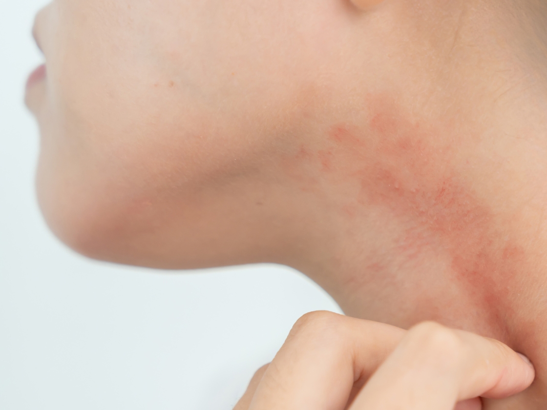 A person’s hand touches an area of recurring dry, red, irritated skin on the side of their neck.
